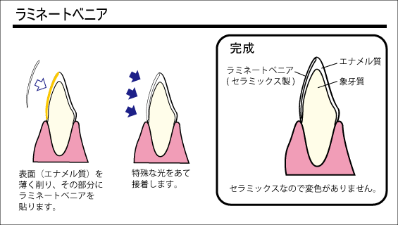 ラミネートベニア